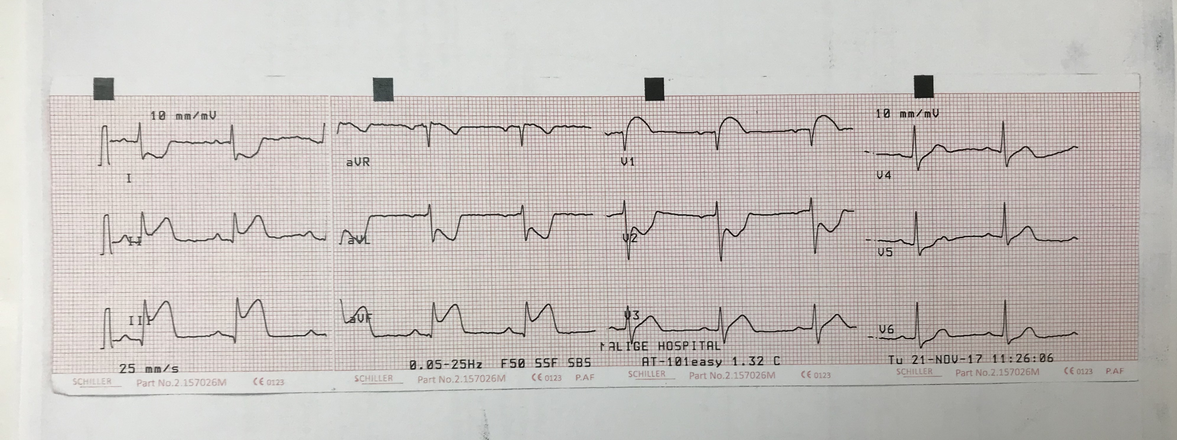 Case Of 34 Year Old Male With Acute MI